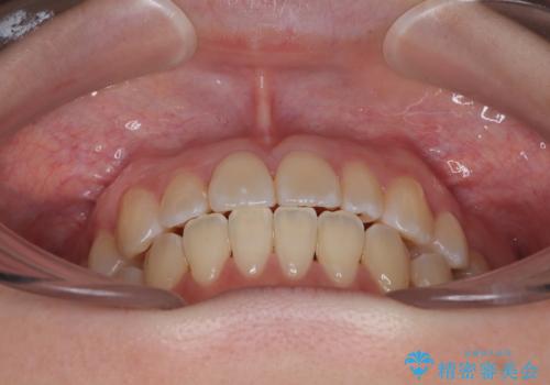 早く・確実に歯並び改善|目立ちにくいワイヤー矯正の治療後