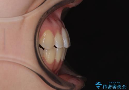 早く・確実に歯並び改善|目立ちにくいワイヤー矯正の治療後