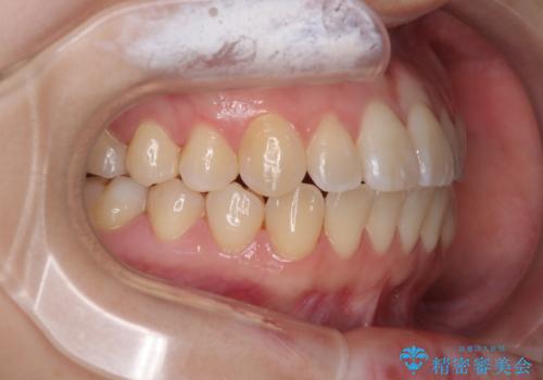 早く・確実に歯並び改善|目立ちにくいワイヤー矯正の治療後