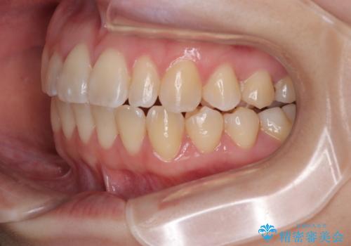 早く・確実に歯並び改善|目立ちにくいワイヤー矯正の治療後