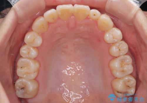 早く・確実に歯並び改善|目立ちにくいワイヤー矯正の治療後