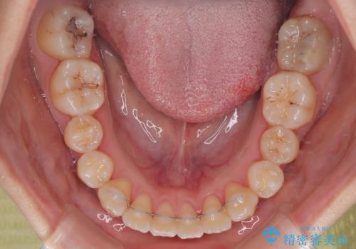 早く・確実に歯並び改善|目立ちにくいワイヤー矯正の治療後