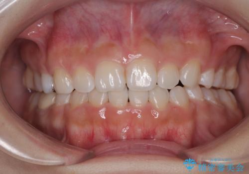 【モニター】デコボコとクロスバイトの前歯　ワイヤー装置での抜歯矯正の治療後