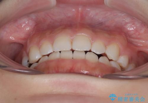 【モニター】デコボコとクロスバイトの前歯 ワイヤー装置での抜歯矯正の治療後