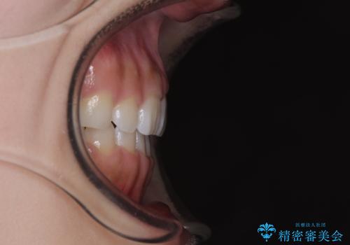 【モニター】デコボコとクロスバイトの前歯 ワイヤー装置での抜歯矯正の治療後