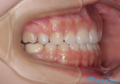 【モニター】デコボコとクロスバイトの前歯 ワイヤー装置での抜歯矯正の治療後