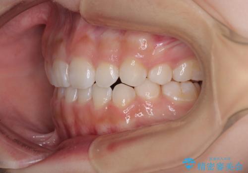 【モニター】デコボコとクロスバイトの前歯　ワイヤー装置での抜歯矯正の治療後