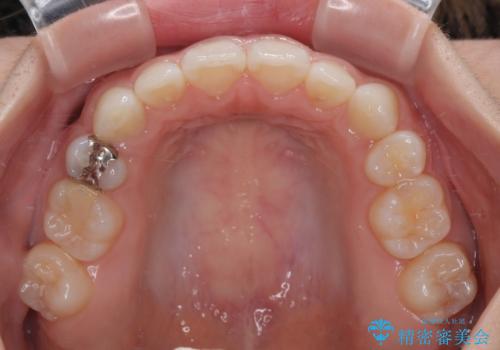 【モニター】デコボコとクロスバイトの前歯 ワイヤー装置での抜歯矯正の治療後