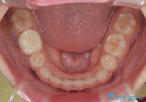 【モニター】デコボコとクロスバイトの前歯 ワイヤー装置での抜歯矯正の治療後