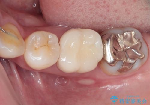 目立つ銀歯をオールセラミッククラウンで自然に|20代女性の審美補綴症例