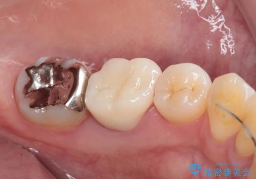 目立つ銀歯をオールセラミッククラウンで自然に|20代女性の審美補綴症例の治療後
