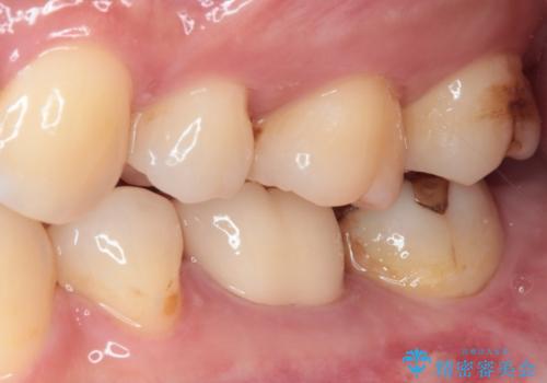 目立つ銀歯をオールセラミッククラウンで自然に|20代女性の審美補綴症例の治療後