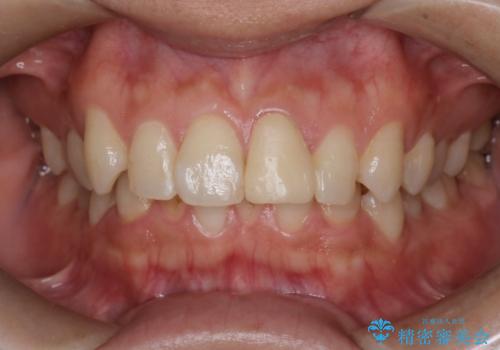 【インビザラインとセラミック】前歯を綺麗に