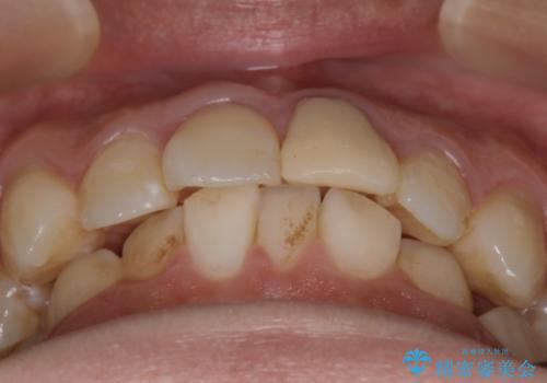 【インビザラインとセラミック】前歯を綺麗にの治療前