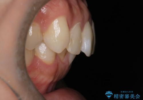 【インビザラインとセラミック】前歯を綺麗にの治療前
