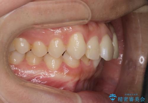 【インビザラインとセラミック】前歯を綺麗にの治療前