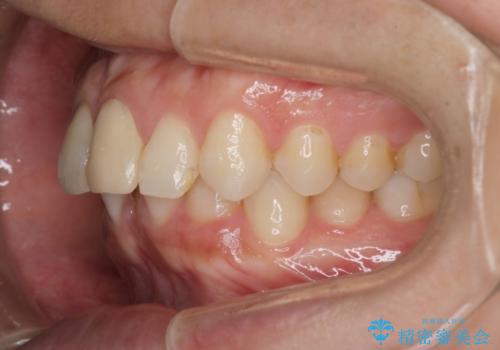 【インビザラインとセラミック】前歯を綺麗にの治療前