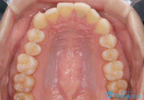 【インビザラインとセラミック】前歯を綺麗にの治療前