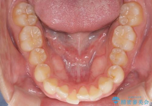 【インビザラインとセラミック】前歯を綺麗にの治療前