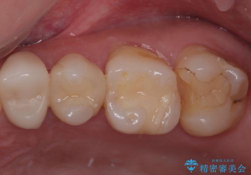 詰め物が欠けたのでやり替えたい セラミックインレー修復の治療前