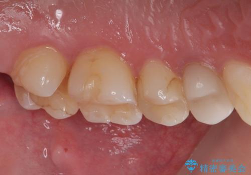 詰め物が欠けたのでやり替えたい　セラミックインレー修復の治療前