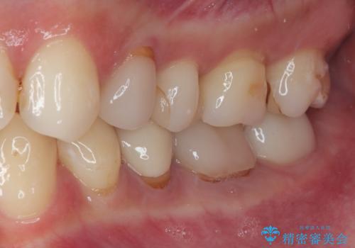 詰め物が欠けたのでやり替えたい　セラミックインレー修復の治療前