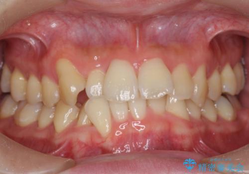 ねじれ・がたつきのある前歯を改善の治療前