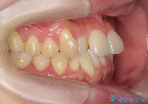 ねじれ・がたつきのある前歯を改善の治療前