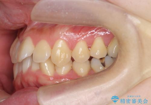 ねじれ・がたつきのある前歯を改善の治療前