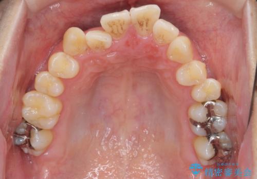 ねじれ・がたつきのある前歯を改善の治療前