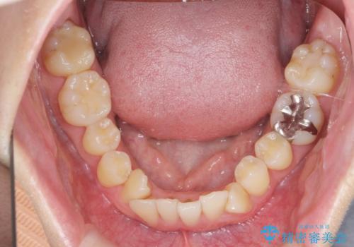 ねじれ・がたつきのある前歯を改善の治療前