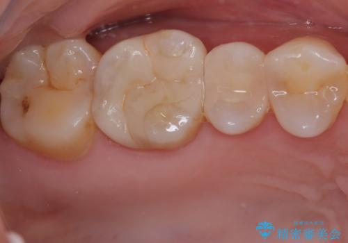 詰め物が欠けたまま放置は危険?見えにくい奥歯のトラブルに注意の治療後