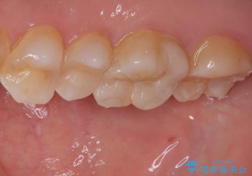 詰め物が欠けたまま放置は危険?見えにくい奥歯のトラブルに注意の治療後