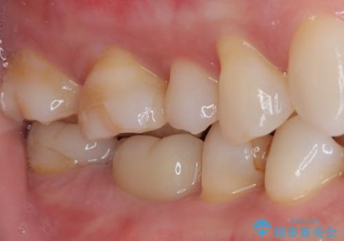 詰め物が欠けたまま放置は危険?見えにくい奥歯のトラブルに注意の治療後