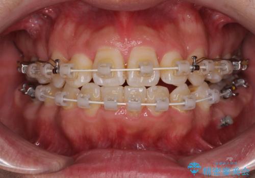 前歯のデコボコを抜歯矯正で改善した症例|目立ちにくい審美装置を使用の治療中