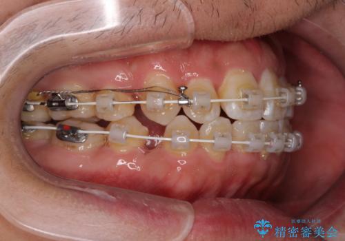 前歯のデコボコを抜歯矯正で改善した症例|目立ちにくい審美装置を使用の治療中