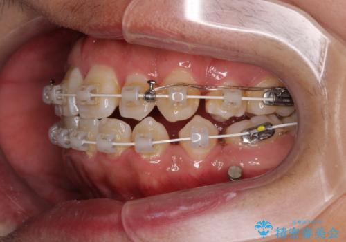 前歯のデコボコを抜歯矯正で改善した症例|目立ちにくい審美装置を使用の治療中