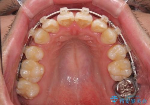 前歯のデコボコを抜歯矯正で改善した症例|目立ちにくい審美装置を使用の治療中