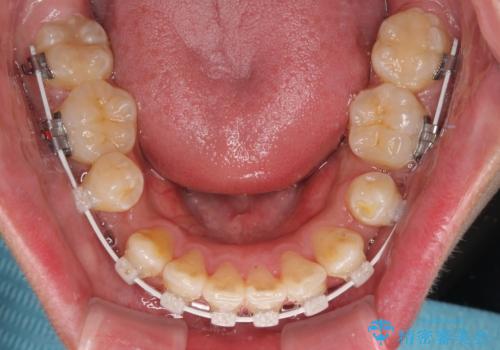 前歯のデコボコを抜歯矯正で改善した症例|目立ちにくい審美装置を使用の治療中
