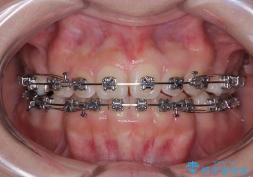 【モニター】デコボコとクロスバイトの前歯 ワイヤー装置での抜歯矯正の治療中