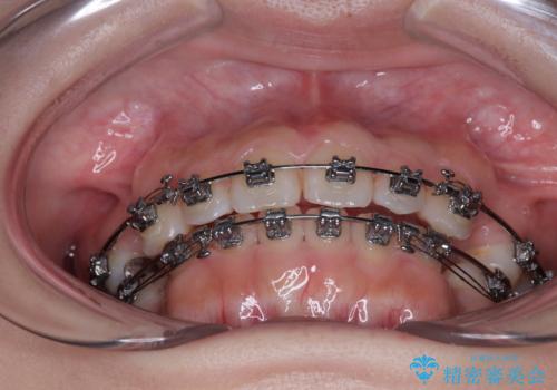 【モニター】デコボコとクロスバイトの前歯　ワイヤー装置での抜歯矯正の治療中