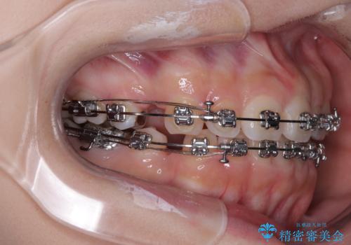 【モニター】デコボコとクロスバイトの前歯 ワイヤー装置での抜歯矯正の治療中