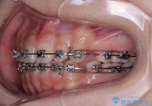 【モニター】デコボコとクロスバイトの前歯 ワイヤー装置での抜歯矯正の治療中