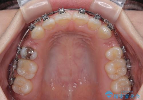 【モニター】デコボコとクロスバイトの前歯 ワイヤー装置での抜歯矯正の治療中