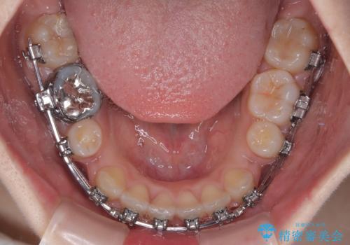 【モニター】デコボコとクロスバイトの前歯 ワイヤー装置での抜歯矯正の治療中