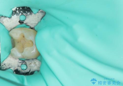 銀の詰め物を白くしたいの治療中