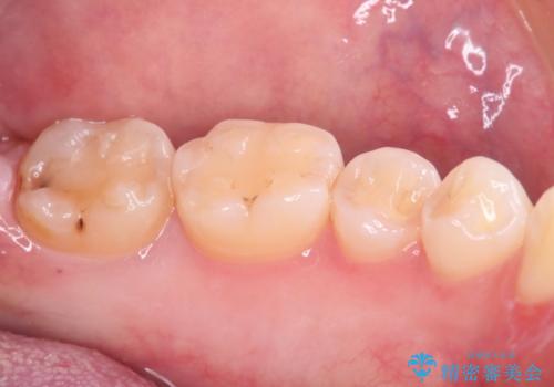 【セラミックインレー】黒いのが気になる