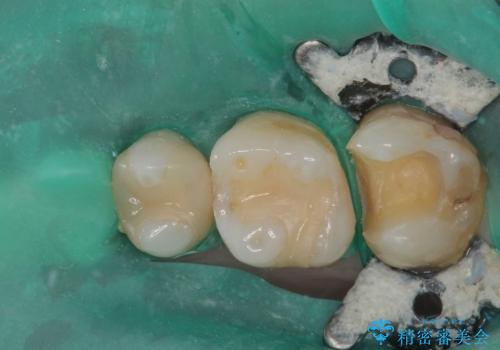 詰め物が欠けたのでやり替えたい セラミックインレー修復の治療中