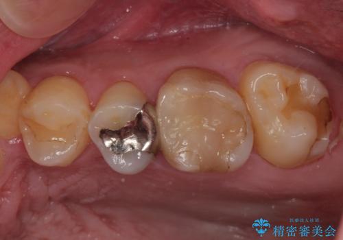 奥歯がたまにしみる MTAによる生活歯髄療法・オールセラミッククラウンの症例 治療前