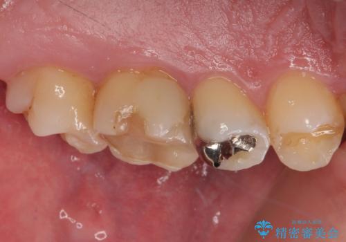 奥歯がたまにしみる MTAによる生活歯髄療法・オールセラミッククラウンの治療前